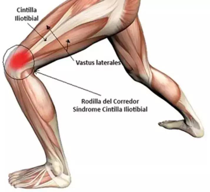 Síndrome de la cintilla ilio-tibial