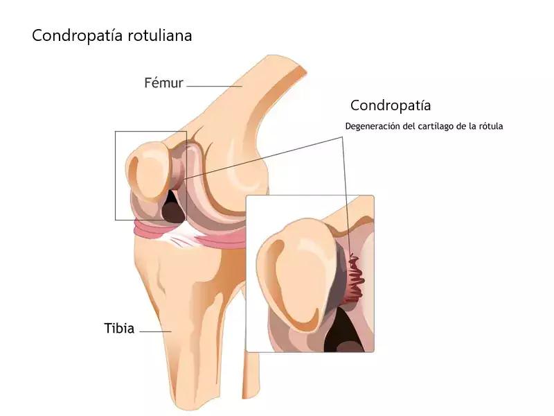 Chondromalacia patellar