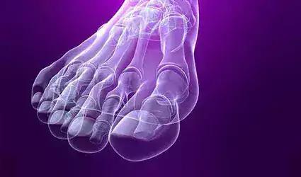 Stress fracture of the metatarsals